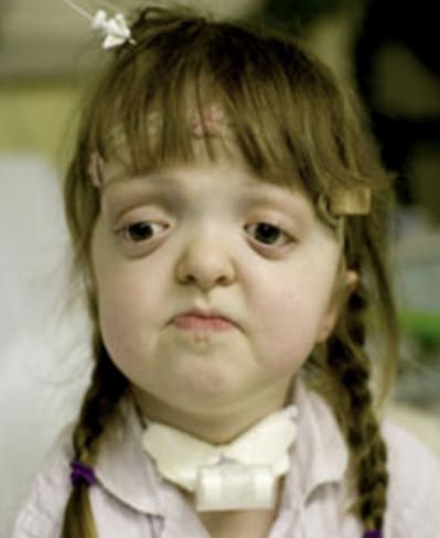 A young girl with a sad expression and braided hair.